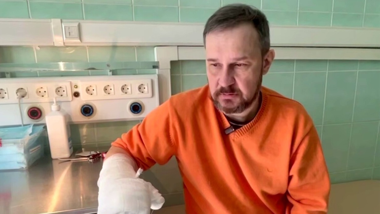 Московские хирурги спасли руку мужчине после того, как он отрезал себе четыре пальца