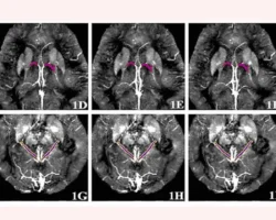Пермский Политех достигает успехов в ранней диагностике Альцгеймера с помощью МРТ вен мозга permskij politeh dostigaet uspehov v rannej diagnostike alczgejmera s pomoshhyu mrt ven mozga-t-nw-ru-0