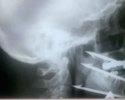 Уникальные спасательные операции провели врачи Роман Стасюк и Олег Виноградов в Волгограде unikalnye spasatelnye operaczii proveli vrachi roman stasyuk i oleg vinogradov v volgograde-t-nw-ru-0