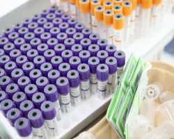 С-реактивный белок поможет выявить воспаления и осложнения ковида sreaktivnyj belok pomozhet vyyavit vospaleniya i oslozhneniya kovida-t-nw-ru-0