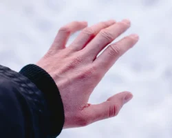 Зимой кожа под защитой как предупредить аллергию на холод zimoj kozha pod zashhitoj kak predupredit allergiyu na holod-t-nw-ru-0