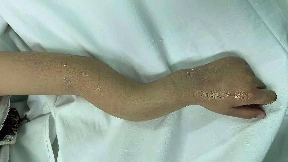 Подмосковные медики спасли ребенку руку, которая сложилась в «гармошку»