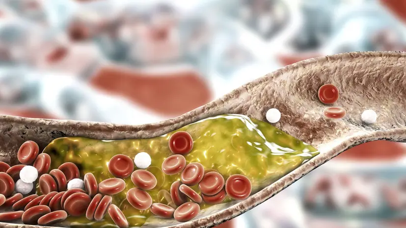 Врач: не нужно голодать несколько дней перед сдачей анализа на уровень холестерина