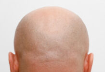 Современная медицина поможет справиться с проблемой выпадения волос у подростков ShavedHeadRearViewSkinheadBaldMan