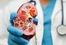 ChronicKidneyDiseaseDoctorHoldingModelForTreatmentUrinarySystem