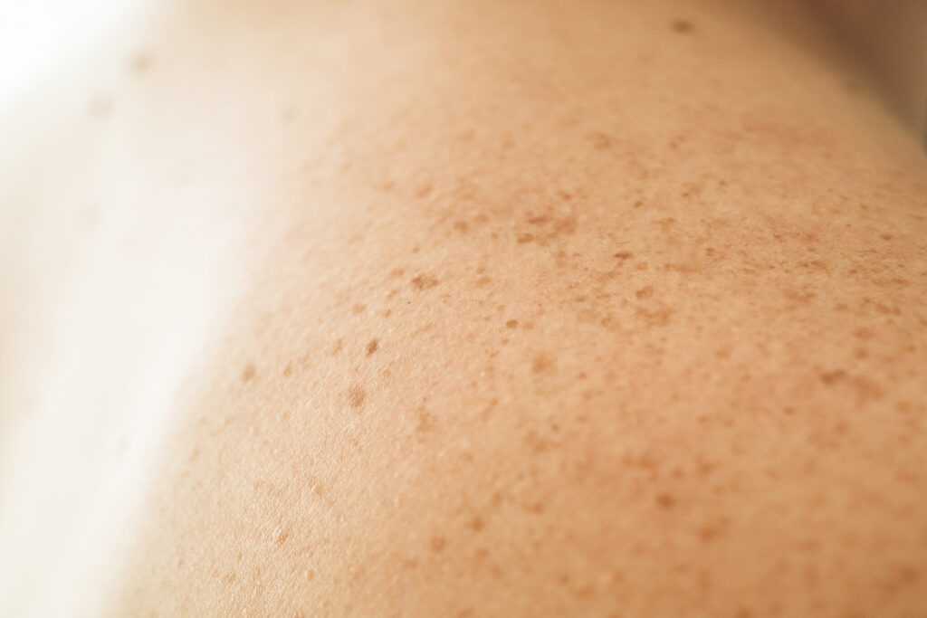Close up detail of the bare skin on a man back with scattered moles and freckles Checking benign moles - ekbonline кожа с веснушками