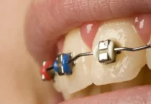 Виктория Радько из EUROKAPPA Clinic рекомендует элайнеры в ортодонтии viktoriya radko iz rekomenduet elajnery v ortodontii-ekbonline-ru-174775256000-0