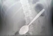 Врачи центра им. Рошаля извлекли 15-сантиметровую ложку из желудка ребёнка в Подмосковье vrachi czentra im roshalya izvlekli 15santimetrovuyu lozhku iz zheludka rebyonka v podmoskove-ekbonline-ru-174645522300-0