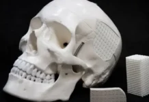 Имплантаты из яичной скорлупы и ПММА помогают при травмах черепа implantaty iz yaichnoj skorlupy i pmma pomogayut pri travmah cherepa-ekbonline-ru-0