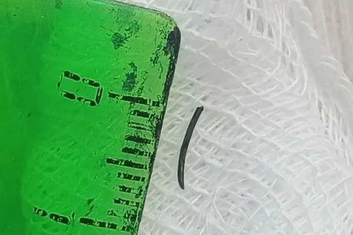 Житель Приморья едва не ослеп из-за отлетевшей щетинки шлифовальной щетки Краевая клиническая больница №2