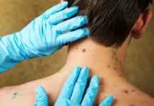 archana kojrala obyasnyaet pochemu vetryanka redko vozvrashhaetsya i kak izbezhat opoyasyvayushhego lishaya-infovzor-ru-0