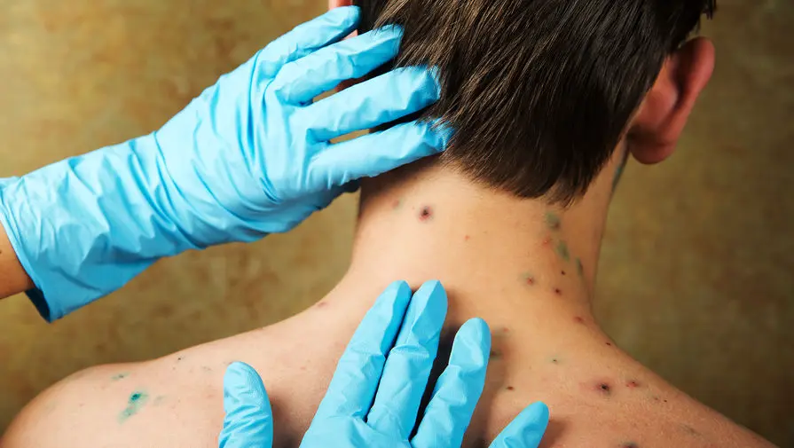 Арчана Койрала объясняет, почему ветрянка редко возвращается и как избежать опоясывающего лишая-0