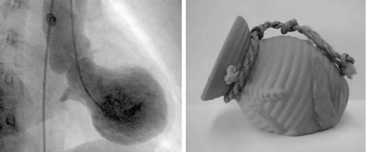 Исследование кардиомиопатии такоцубо показывает влияние адреналина и половые различия риска-0