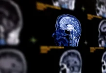 Кирилл Орлов из ФМБА предупреждает о проявлениях аневризмы мозга kirill orlov iz fmba preduprezhdaet o proyavleniyah anevrizmy mozga-stanural-ru-174802182800-0