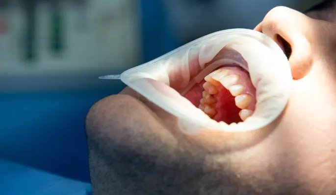 Стоматолог Тумашевич назвал три причины выпадения коронки