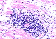 Ольга Благова и Сеченовский Университет совершили прорыв в диагностике миокардита olga blagova i sechenovskij universitet sovershili proryv v diagnostike miokardita-stanural-ru-0