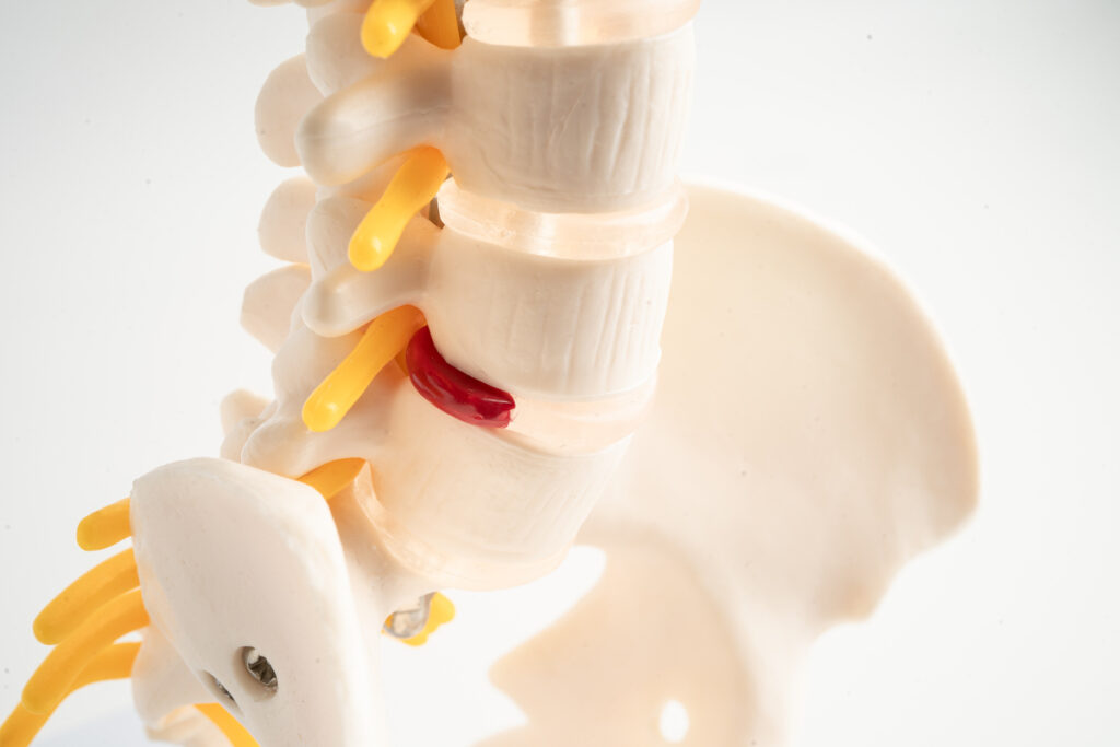 Поясничный отдел позвоночника, межпозвоночные диски