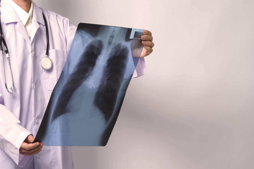 Врач держит и проверяет рентгеновскую пленку легких