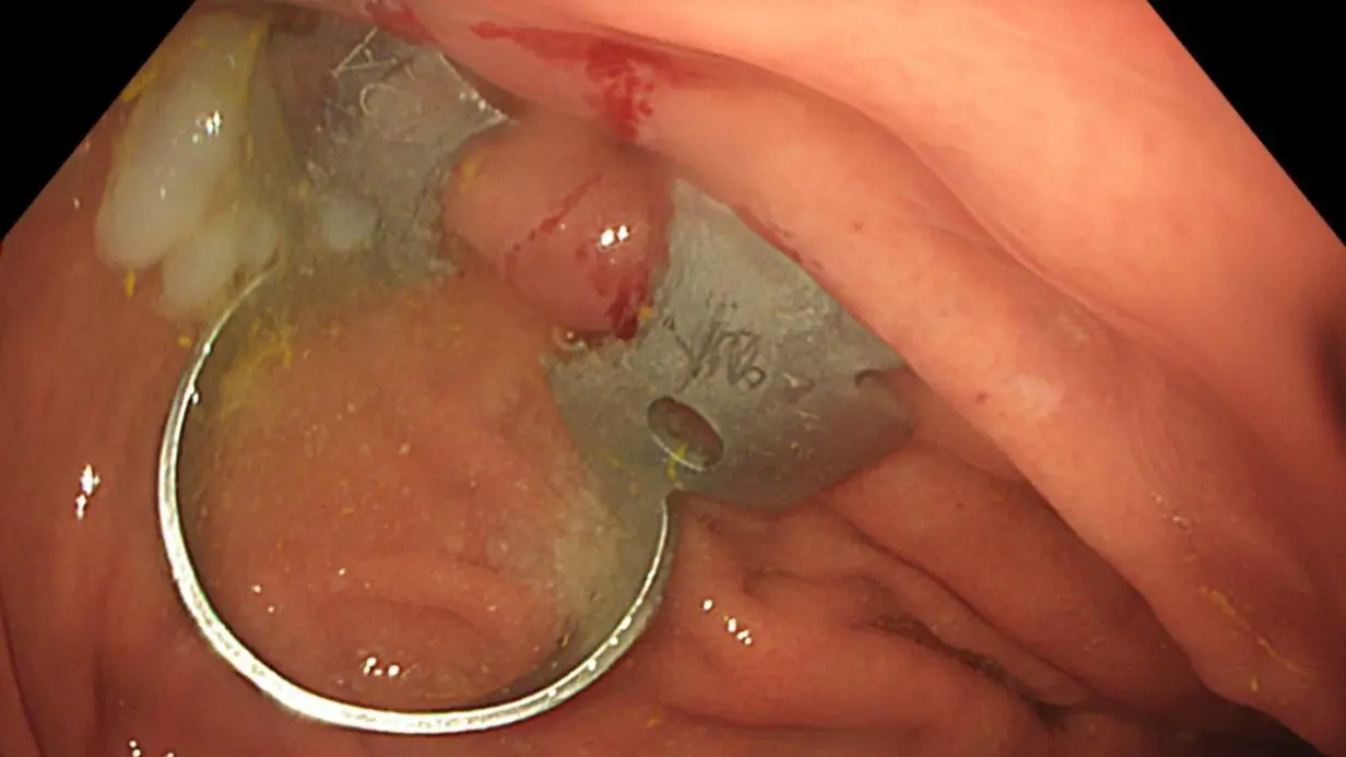 Подмосковные врачи вытащили острую стоматологическую скобу из желудка школьницы