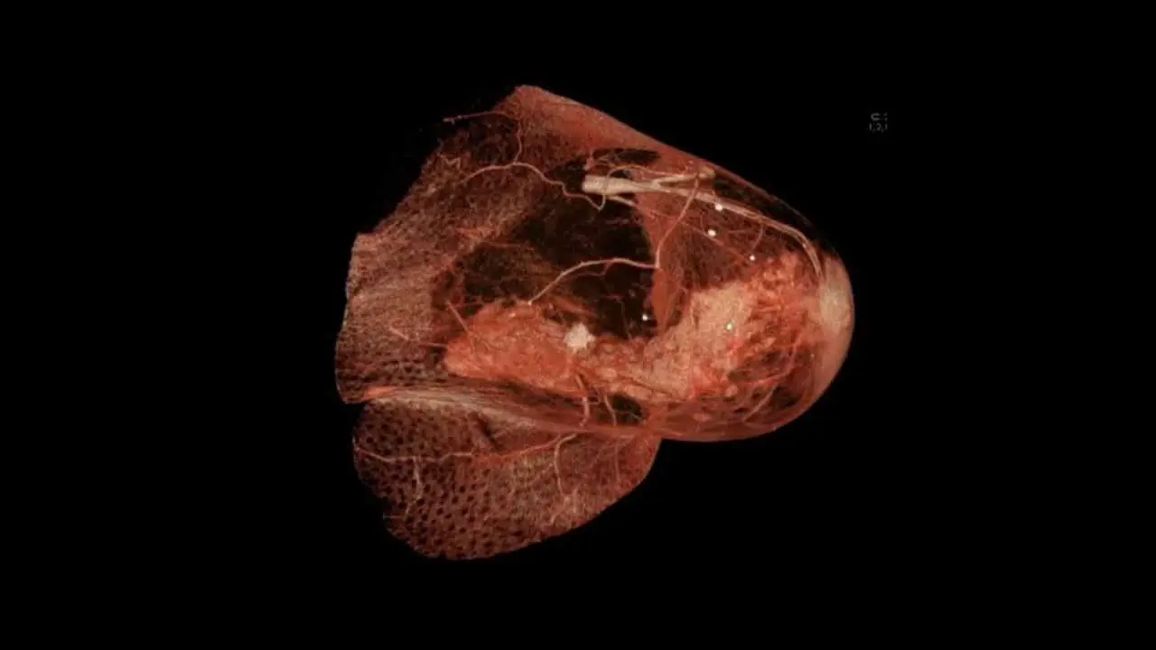 НИУ ВШЭ о роли IGF2 и фибробластов в рецидивах рака молочной железы-0