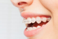 Сабит Алиев объясняет противопоказания к установке брекетов при воспалении дёсен sabit aliev obyasnyaet protivopokazaniya k ustanovke breketov pri vospalenii dyosen-dmvv-ru-174557845300-0