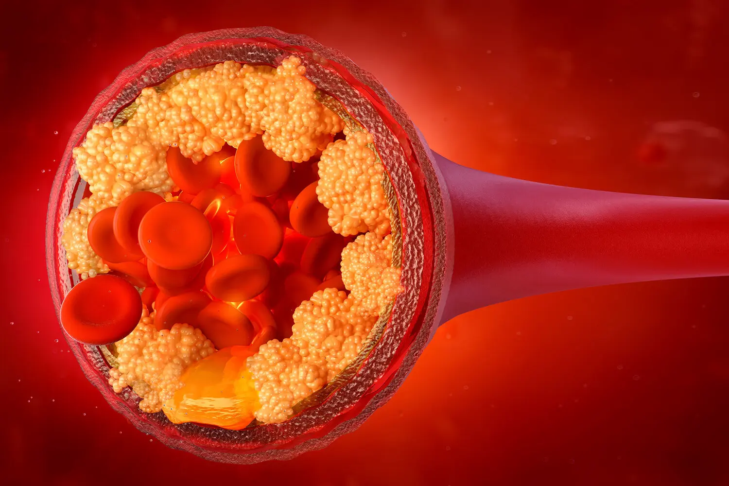 Исследование Техасского университета показывает снижение риска Альцгеймера при контроле холестерина-0