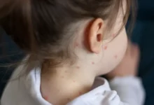 Никита Волков и ВОЗ обсуждают важность вакцинации против кори nikita volkov i voz obsuzhdayut vazhnost vakczinaczii protiv kori-dmvv-ru-0