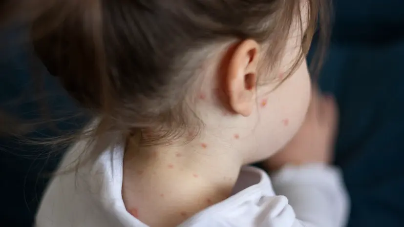 Педиатр Волков: вирус кори может временно стирать иммунную память организма