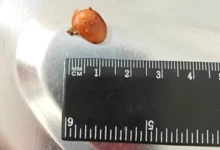 Видновская больница вернула слух, извлекая забытые беруши vidnovskaya bolnicza vernula sluh izvlekaya zabytye berushi-dmvv-ru-0