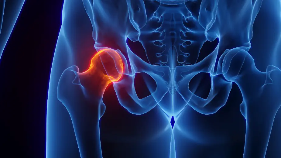 Замена тазобедренного сустава: риски, восстановление, операция