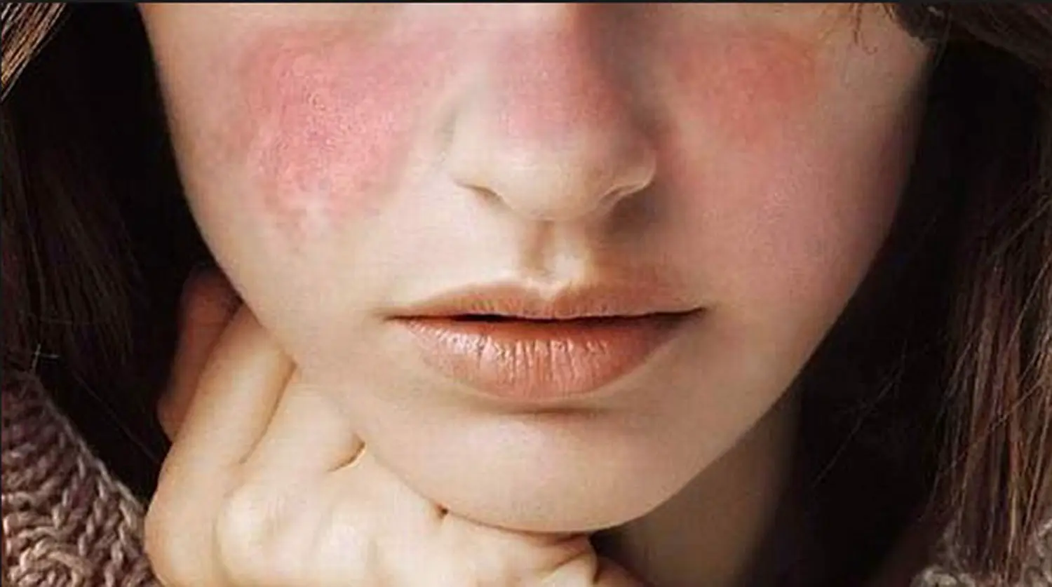 Минздрав и ассоциация «Надежда» усиливают поддержку пациентов с красной волчанкой-0