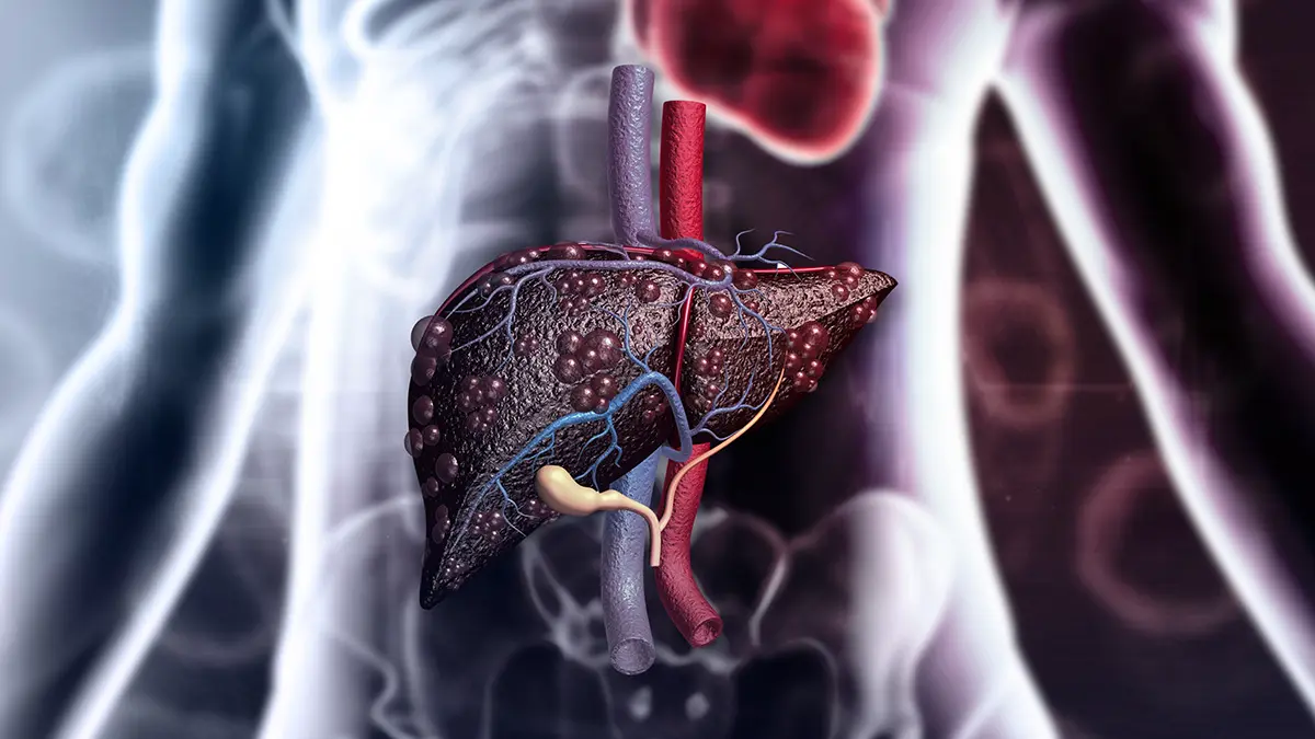 Врач Чернышова объяснила «бум» цирроза в России и мире