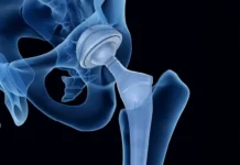 Ученые Пермского Политеха совершенствуют расчет срока службы углеродных протезов uchenye permskogo politeha sovershenstvuyut raschet sroka sluzhby uglerodnyh protezov-gazetarf-ru-0