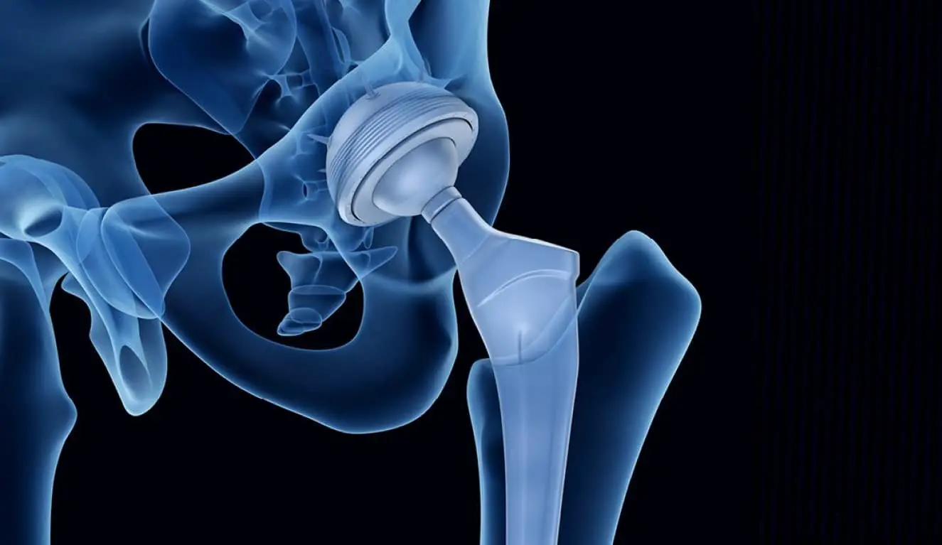 Ученые Пермского Политеха совершенствуют расчет срока службы углеродных протезов-0