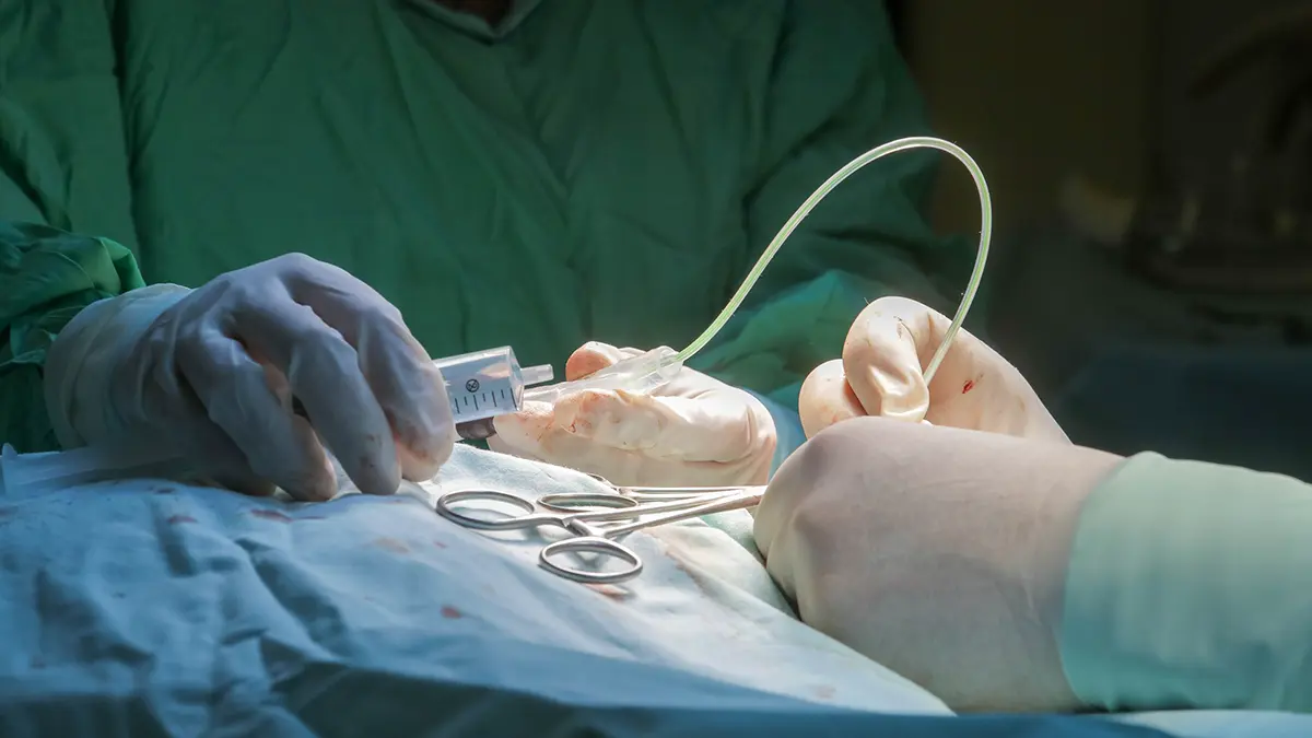 Россиянам с ожирением по полису ОМС стала доступна хирургическая помощь