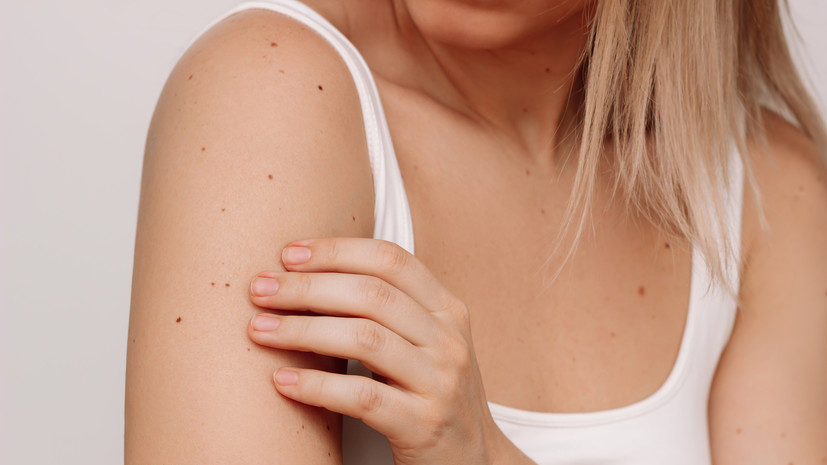 Врач Заторская посоветовала при изменении цвета родинки показаться специалисту