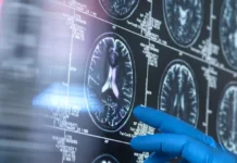 Игорь Мальцев предупреждает о рисках атеросклероза и гипертонии для деменции igor malczev preduprezhdaet o riskah ateroskleroza i gipertonii dlya demenczii-urbandigest-ru-174860460400-0