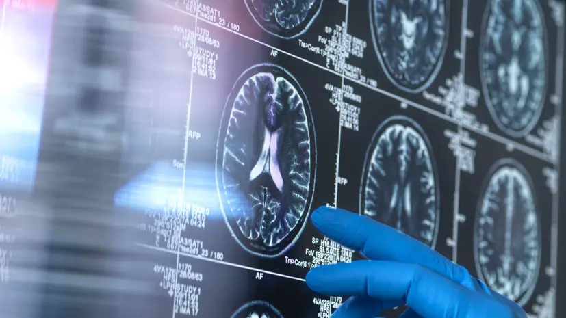 Врач Мальцев: атеросклероз повышает риск развития сосудистой деменции