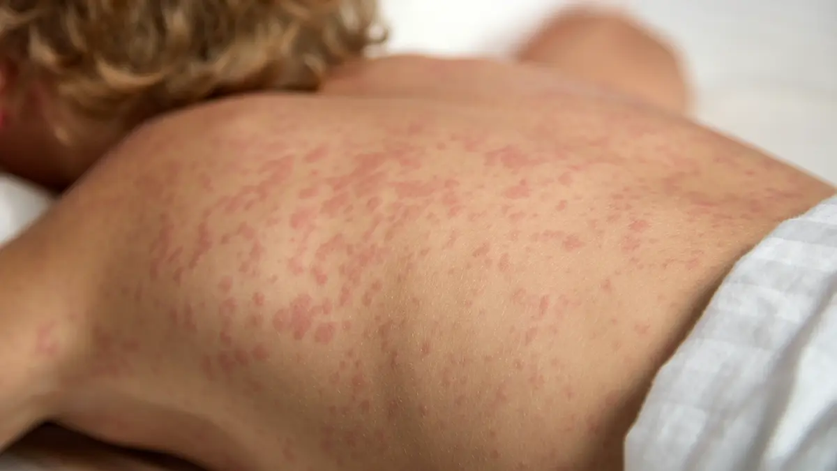 Роспотребнадзор подтвердил случай кори у студента филфака МГУ