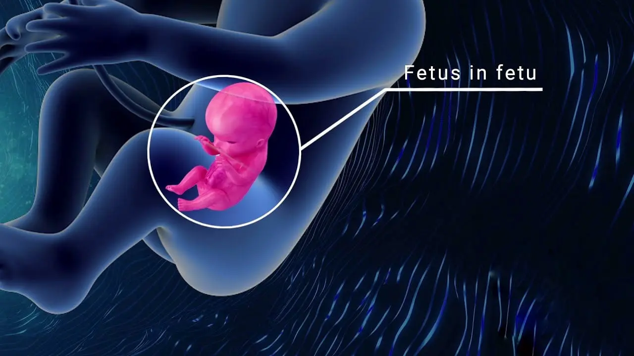 Младенец с редкой аномалией развития спасён благодаря медицине Fortis-0