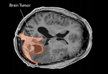 Наблюдения TriNetX о депо-медроксипрогестероне ацетате и менингиомах nablyudeniya o depomedroksiprogesterone aczetate i meningiomah-urbandigest-ru-0