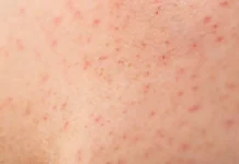 Эксперты СберЗдоровье дают советы по предотвращению скарлатины у взрослых eksperty sberzdorove dayut sovety po predotvrashheniyu skarlatiny u vzroslyh-urbandigest-ru-0