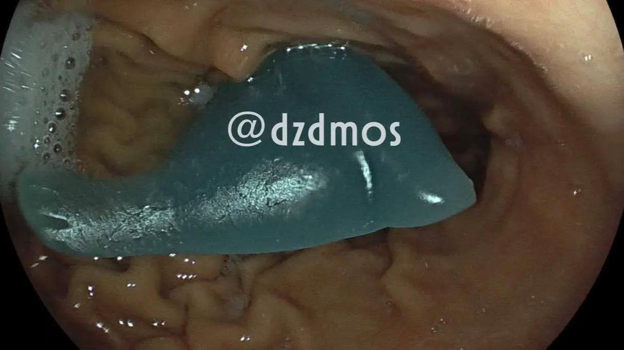 Врачи достали силиконового дельфина из желудка пятилетнего ребенка в Москве