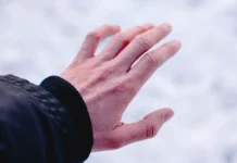 Доктор Сирмайс о связи ксероза, дерматита и аллергии с холодом зимой doktor sirmajs o svyazi kseroza dermatita i allergii s holodom zimoj-urbandigest-ru-0