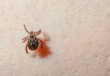 zashhita ot kleshhej spasaet zhizni ot lihoradki v sivase-urbandigest-ru-0