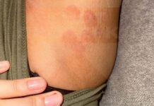 В московском салоне красоты клиентка получила ожоги после процедуры лазерной эпиляции 65030019-fe45-4189-bf69-373d5b3001b4-679e166a