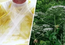 Алексей победил тяжелые ожоги от борщевика благодаря НИИ Склифосовского aleksej pobedil tyazhelye ozhogi ot borshhevika blagodarya nii sklifosovskogo-news-blog-ru-0