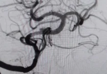 Успешная операция спасла пациента с ночным инсультом в Мытищинской больнице uspeshnaya operacziya spasla paczienta s nochnym insultom v mytishhinskoj bolnicze-news-blog-ru-0