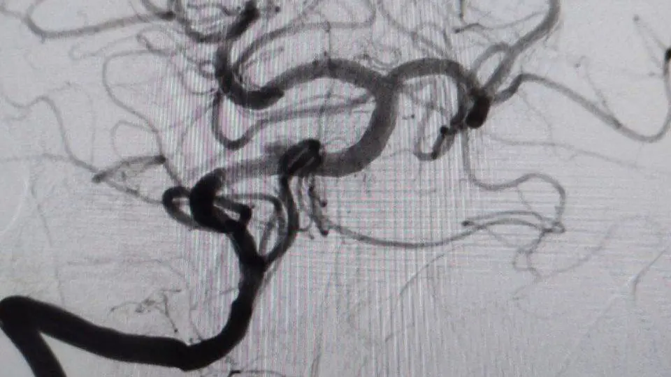 Врачи в Подмосковье спасли мужчину с редким «ночным» инсультом