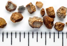 tiazidnye diuretiki i allopurinol dayut nadezhdu na profilaktiku kamnej-news-blog-ru-0